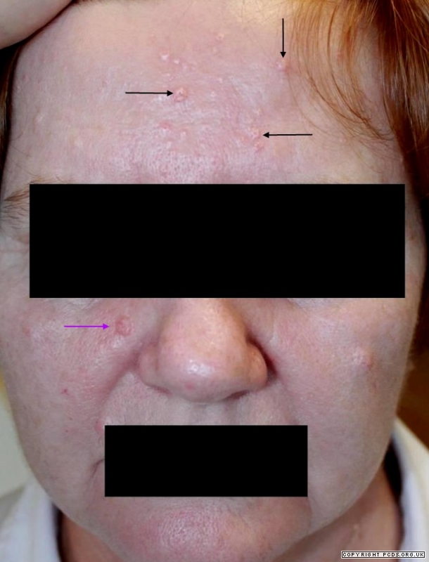 Bcc Basal Cell Carcinoma