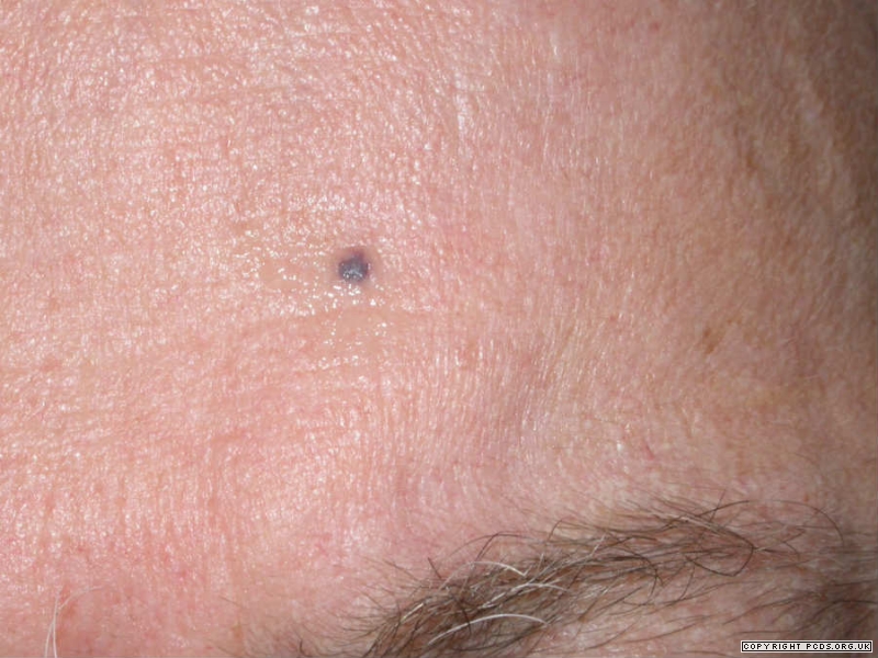 Blue nevus - Symptoms and causes - wide 2