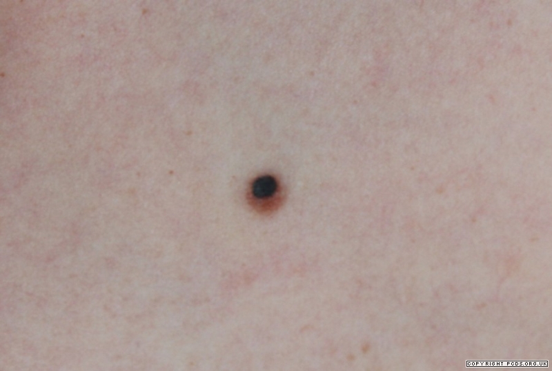 cancerous black moles