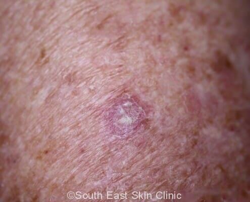 Squamous Cell Carcinoma of the upper arm
