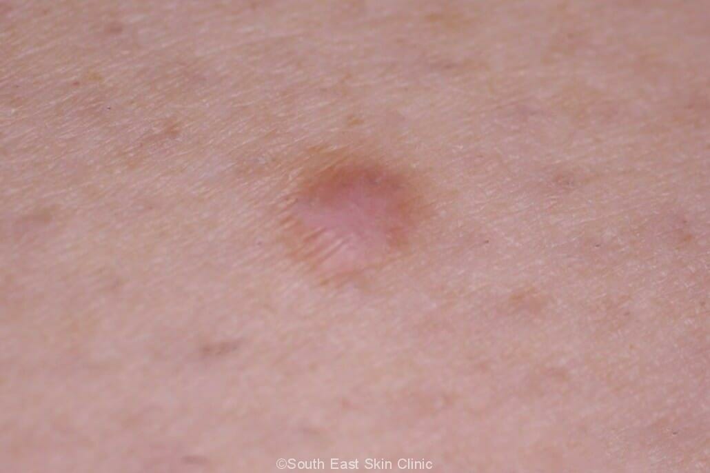 Dermatofibroma - South East Skin Clinic blog