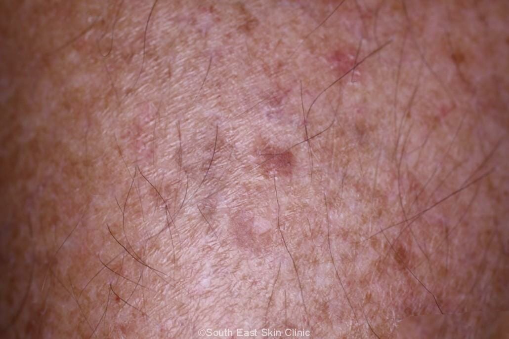 Age Spots Brisbane Skin Doctor Age Spots Brisbane Skin Doctor