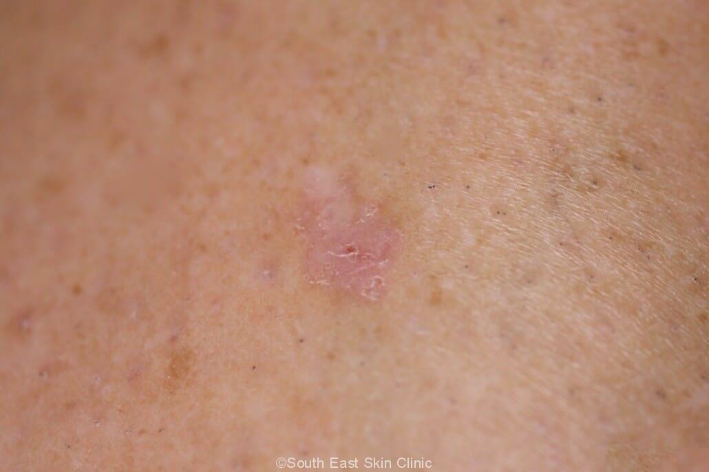 superficial basal cell carcinoma
