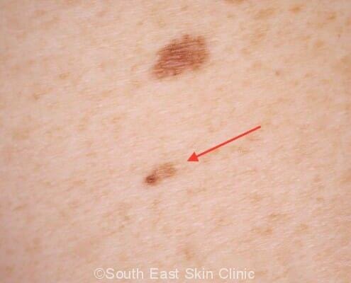 The arrow points to a moderately dysplastic compound nevus