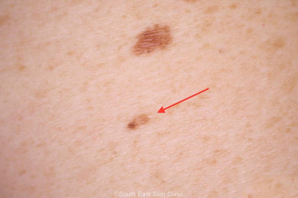 punch-biopsy-for-a-mildly-atypical-mole-scary-symptoms