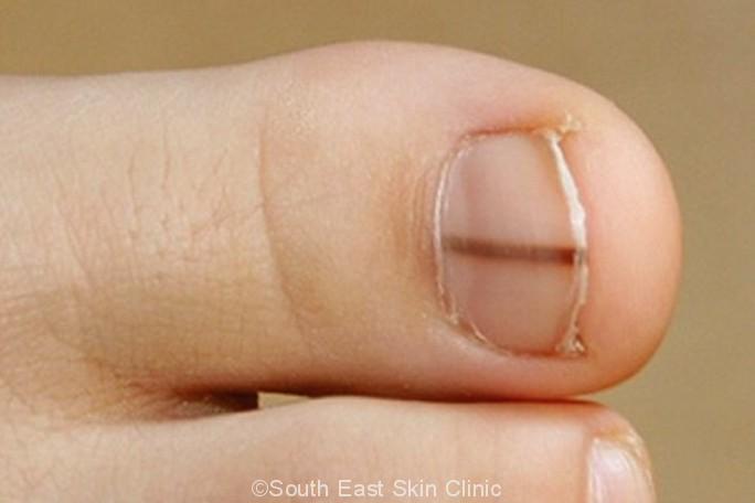 Subungual Melanoma  Fingernail Cancer  Causes Symptoms Diagnosis  Treatment and Prevention