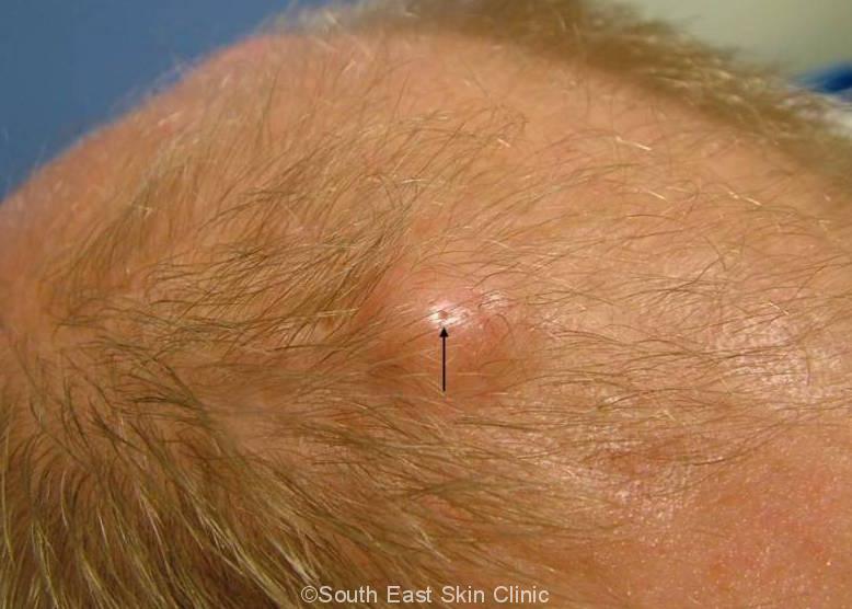 Epidermoid Cyst Sebaceous Cyst South East Skin Clinic