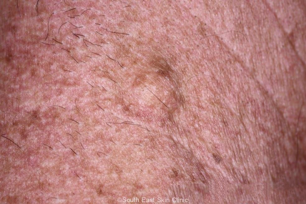 Sebaceous Cyst Anatomy at Lorenzo Marrs blog