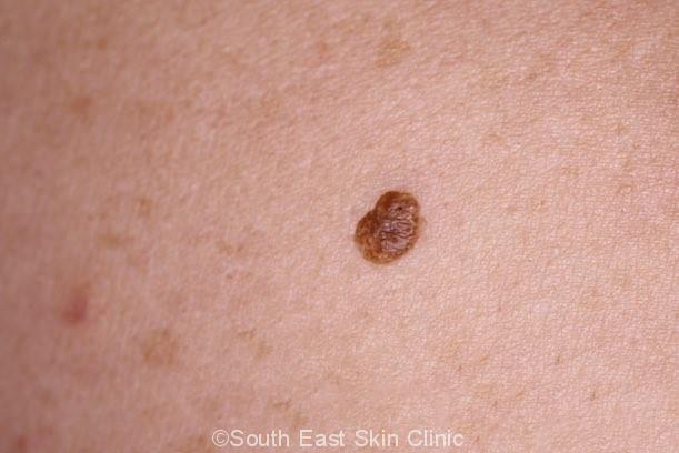 Seborrhoeic Keratosis How To Idenitify Seb K Extensive Gallery Seborrhoeic Keratosis How To Idenitify Seb K Extensive Gallery