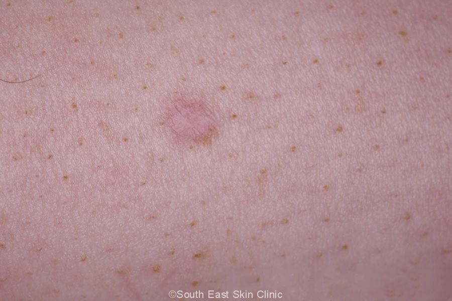 Dermatofibroma Dimple Sign