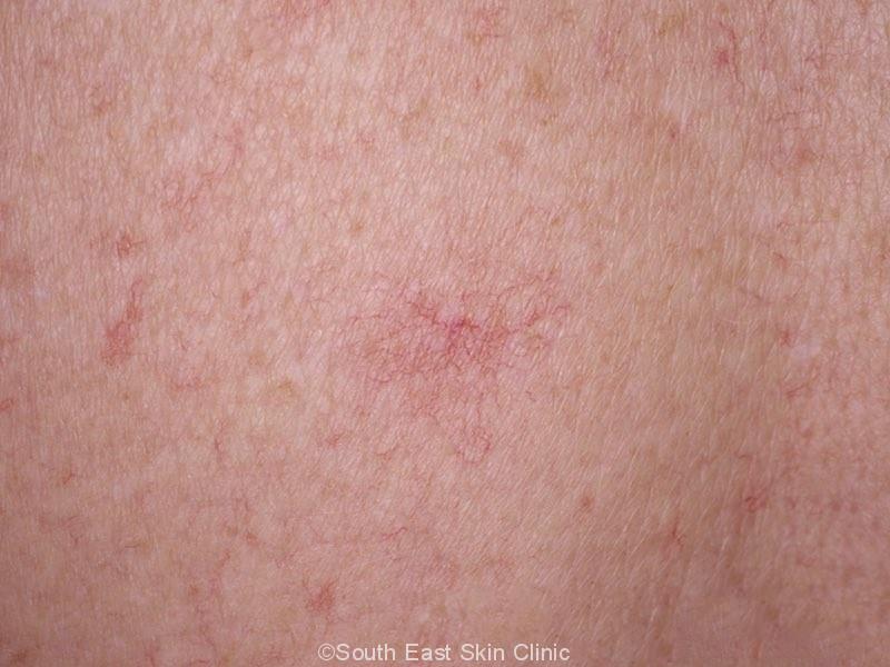 Haemangioma South East Skin Clinic Haemangioma South East Skin Clinic