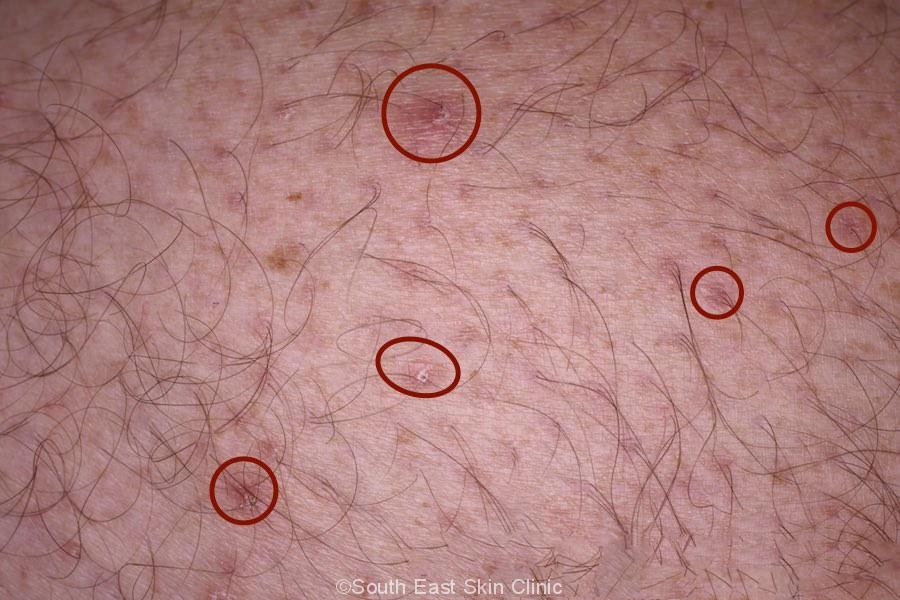 folliculitis genital area