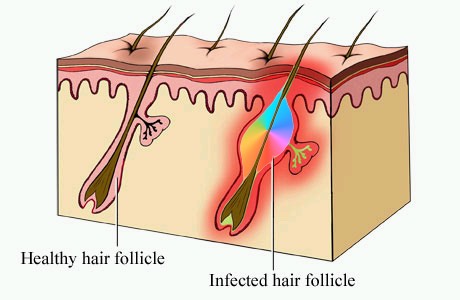 folliculitis diagram shows how the inflammation is centred around a hair follicle