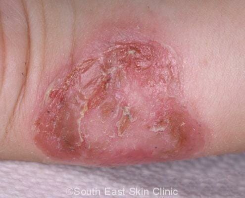 School sores in a 5 year old - by the wrist