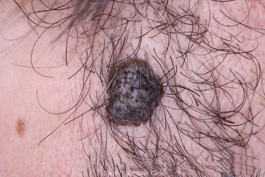 seborrheic keratosis scalp