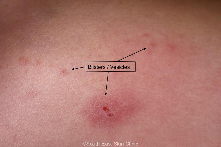 Shingles - Six Snippets everyone should know.