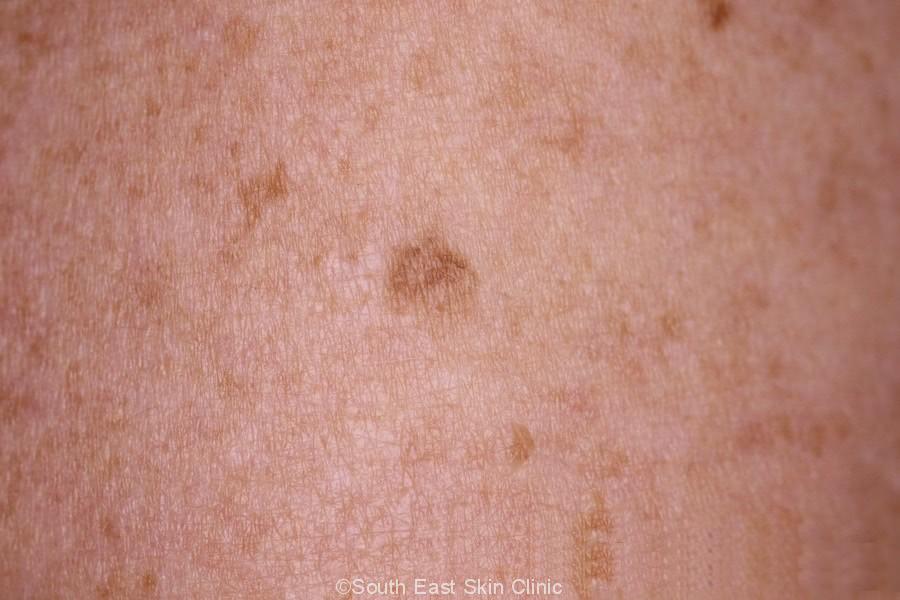 Seborrhoeic Keratosis How To Idenitify Seb K Extensive Gallery Seborrhoeic Keratosis How To Idenitify Seb K Extensive Gallery
