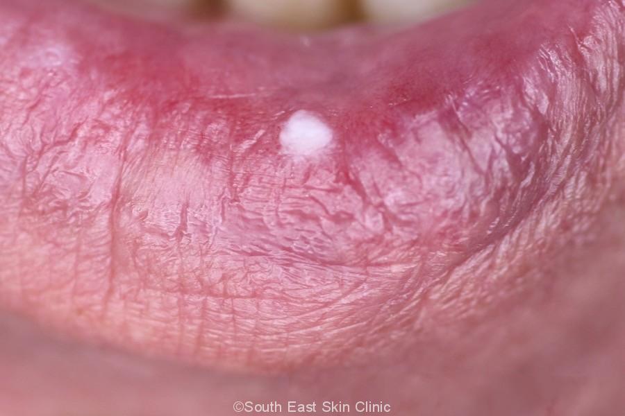 Cheilitis South East Skin Clinic cheilitis-south-east-skin-clinic