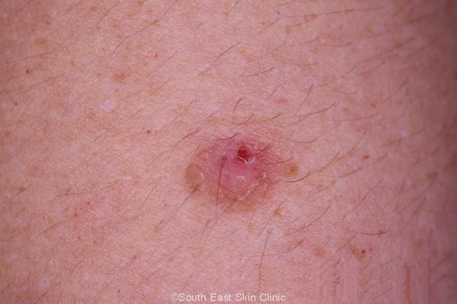Wart Pictures On Arm At Gladys Zachery Blog wart-pictures-on-arm-at-gladys-zachery-blog