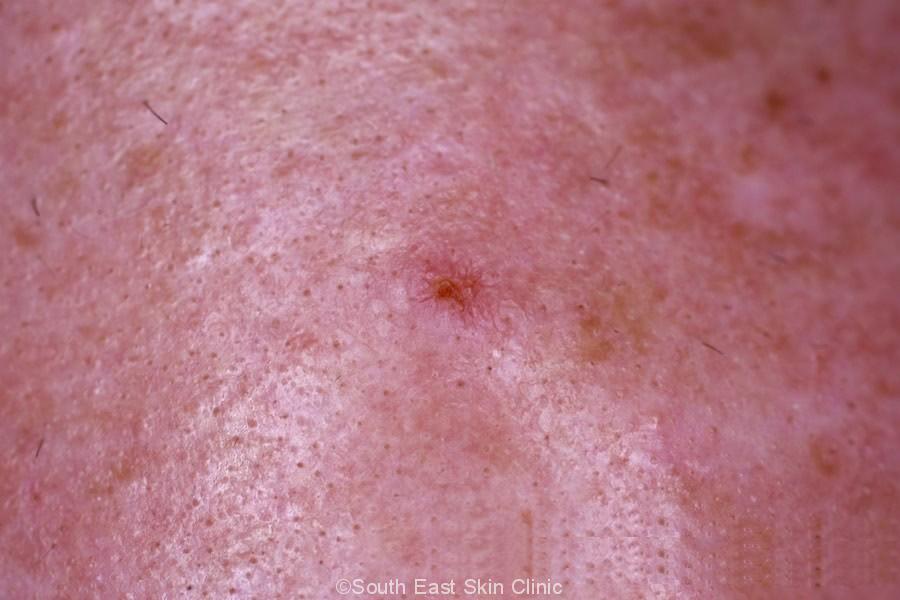 SCC Squamous Cell Carcinoma South East Skin Clinic scc-squamous-cell-carcinoma-south-east-skin-clinic