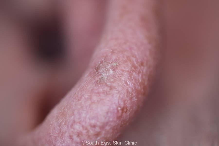 Iec Intraepidermal Carcinoma South East Skin Clinic