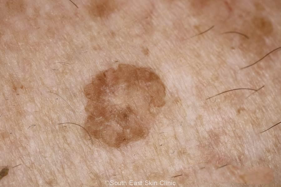 Aging Spots on Legs: What's Normal, What's Not