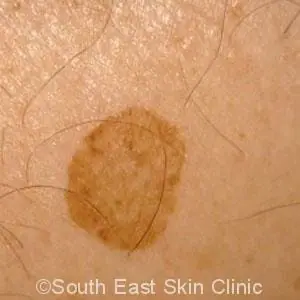 Age Spots Brisbane Skin Doctor Age Spots Brisbane Skin Doctor