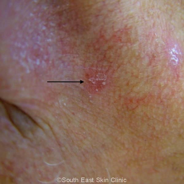Solar Keratosis Brisbane Skincheck Clinic