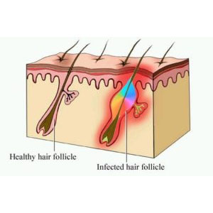 Folliculitis - A term many Australians are familiar with but why?