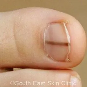 Nail Melanoma South East Skin Clinic Nail Melanoma South East Skin Clinic